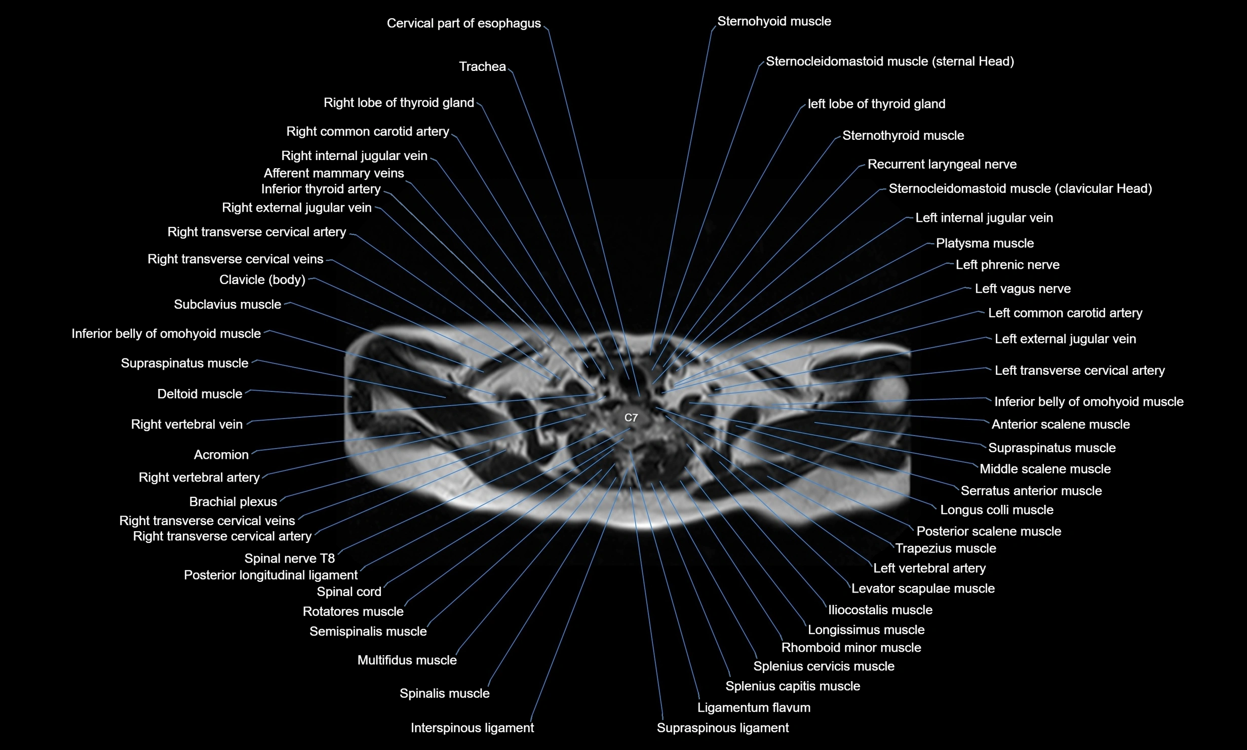 MRI chest axial  cross sectional anatomy 3T radiology  image-img-00001-00004.webp